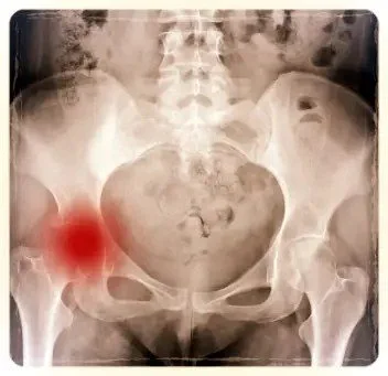 Hip imaging with highlighted painful region