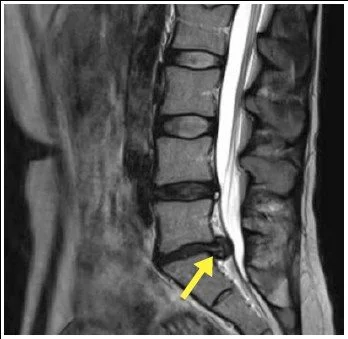 Lumbar MRI showing a disc bulge